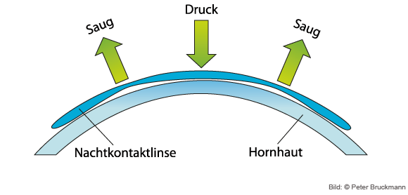 orthokeratologie